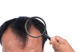 Przyczyny łysienia u kobiet i mężczyzn