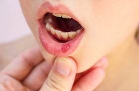 Afty u dzieci — skąd się biorą i jak wyleczyć nadżerki w jamie ustnej?