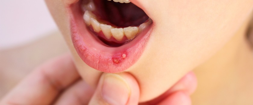 Afty u dzieci — skąd się biorą i jak wyleczyć nadżerki w jamie ustnej?