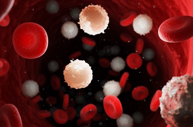 Przewlekła białaczka limfocytowa – objawy, leczenie, rokowania