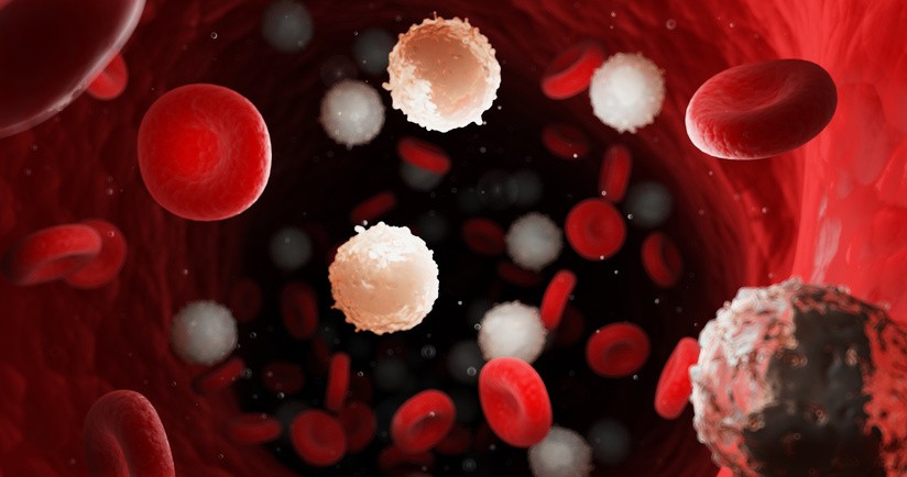 Przewlekła białaczka limfocytowa – objawy, leczenie, rokowania