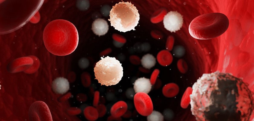 Przewlekła białaczka limfocytowa – objawy, leczenie, rokowania