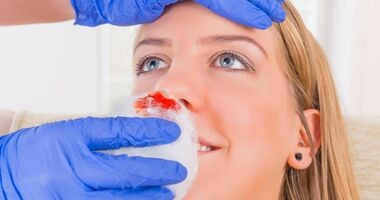 Krwawienie z nosa