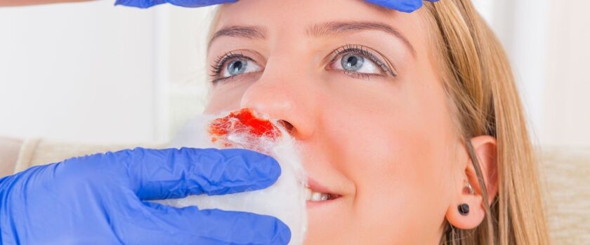 Krwawienie z nosa