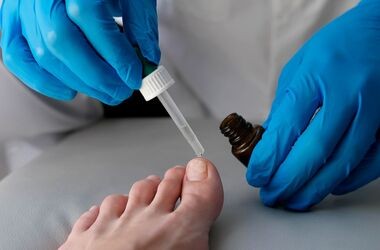 Nakładnie leku na grzybicę paznokci u nóg. Grzybica paznokci u stóp.