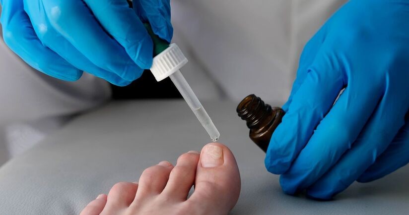 Nakładnie leku na grzybicę paznokci u nóg. Grzybica paznokci u stóp.