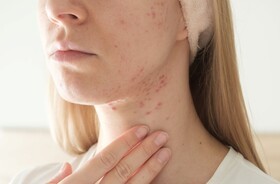 trądzik hormonalny, trądzik na żuchwie, twarz kobiety z trądzikiem na żuchwie, zmiany trądzikowe