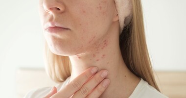 trądzik hormonalny, trądzik na żuchwie, twarz kobiety z trądzikiem na żuchwie, zmiany trądzikowe