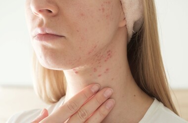 trądzik hormonalny, trądzik na żuchwie, twarz kobiety z trądzikiem na żuchwie, zmiany trądzikowe