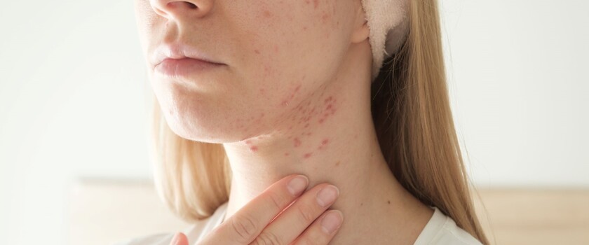 trądzik hormonalny, trądzik na żuchwie, twarz kobiety z trądzikiem na żuchwie, zmiany trądzikowe