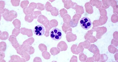 Neutrofile – przyczyny podwyższonego i obniżonego poziomu neutrocytów we krwi