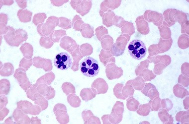 Neutrofile – przyczyny podwyższonego i obniżonego poziomu neutrocytów we krwi