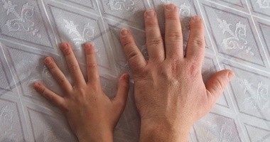 Dłoń osoby z akromegalią na tle standardowych rozmiarów dloni ludzkiej