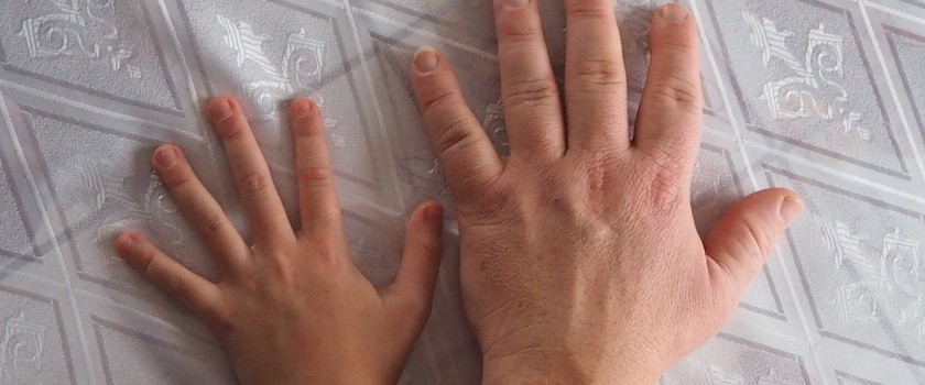 Dłoń osoby z akromegalią na tle standardowych rozmiarów dloni ludzkiej