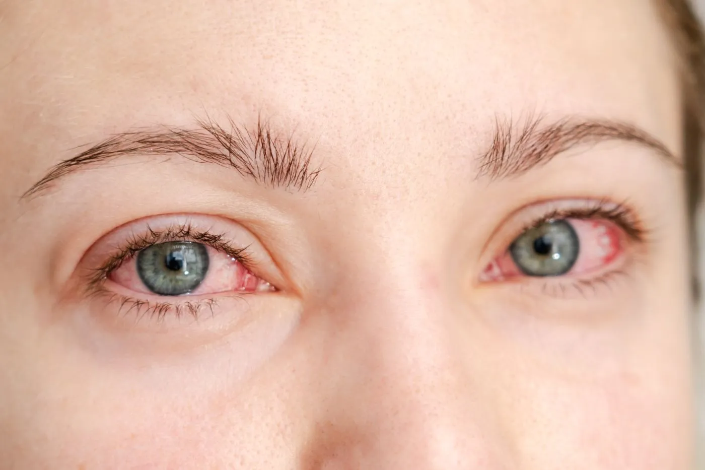 oczy przy alergicznym zapaleniu spojówek, jak wygląda alergiczne zapalenie spojówek, alergiczne zapalenie spojówek zdjęcia