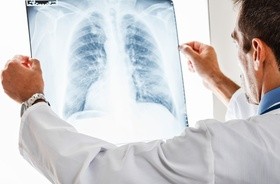Zapalenie płuc &#8211; objawy i leczenie