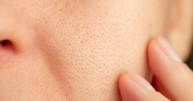 rozszerzone pory, rozszerzone pory na twarzy