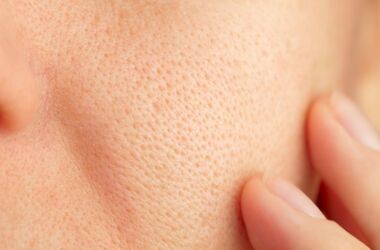 rozszerzone pory, rozszerzone pory na twarzy