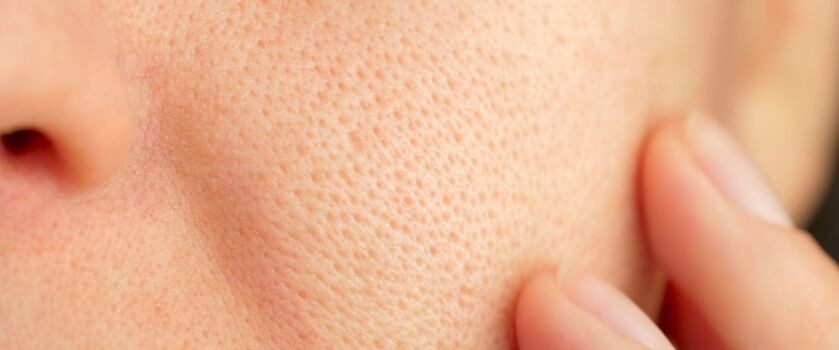rozszerzone pory, rozszerzone pory na twarzy
