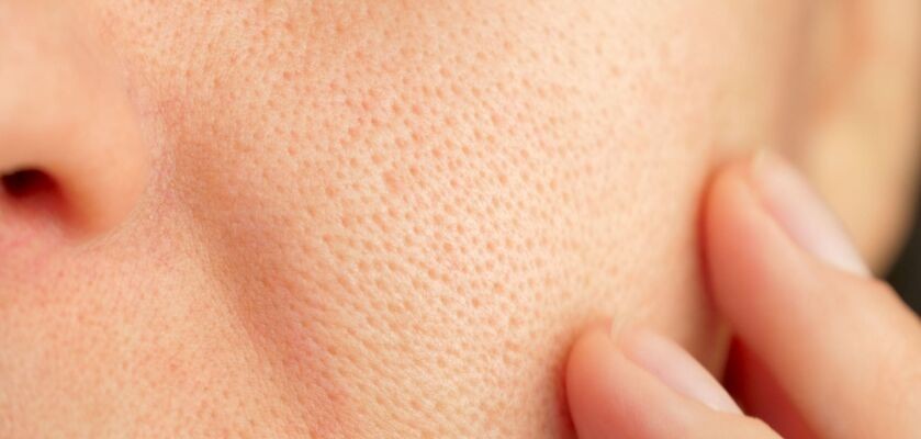 rozszerzone pory, rozszerzone pory na twarzy