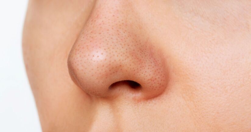 zaskórniki, zaskórniki zamknięte, trądzik zaskórnikowy, zaskórniki na nosie