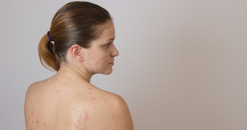 Trądzik młodzieńczy (pospolity) – przyczyny występowania i sposób leczenia