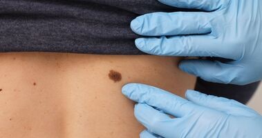 czerniak, badanie pieprzyka przez dermatologa