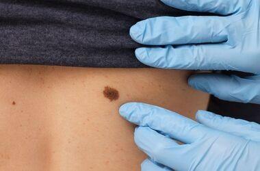 czerniak, badanie pieprzyka przez dermatologa