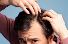 dieta na wypadanie włosów, wypadanie włosów, mężczyzna przeczesuje włosy