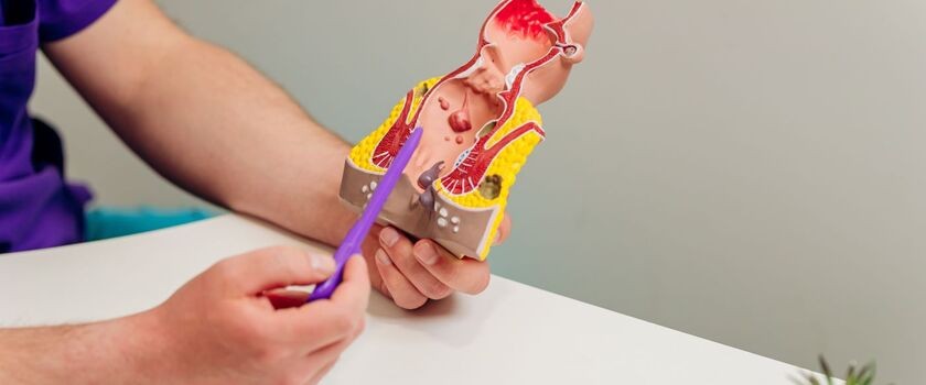 Medyk trzymający model odbytu, najczęstsze choroby odbytu.