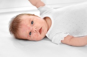 Egzema u dzieci i niemowląt – jak ją rozpoznać?