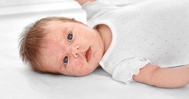 Egzema u dzieci i niemowląt – jak ją rozpoznać?