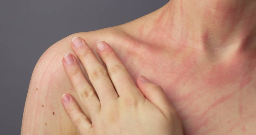 Zbliżenie na kobiecy dekolt, skóra z dermografizmem, pokrzywka dermograficzna, pisanie po skórze.