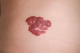 naczyniak, naczyniak na skórze