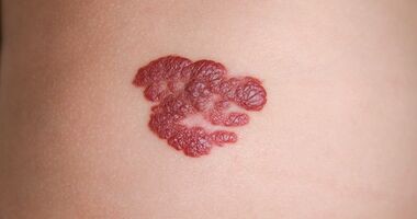 naczyniak, naczyniak na skórze