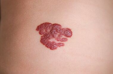 naczyniak, naczyniak na skórze