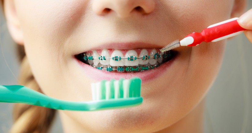 Jak prawidłowo dbać o zęby w aparacie ortodontycznym?