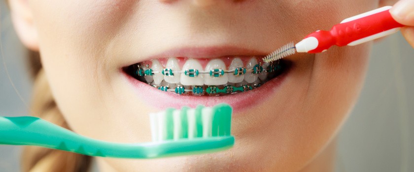 Jak prawidłowo dbać o zęby w aparacie ortodontycznym?
