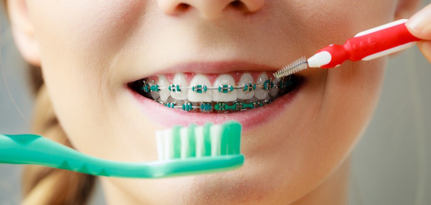 Jak prawidłowo dbać o zęby w aparacie ortodontycznym?