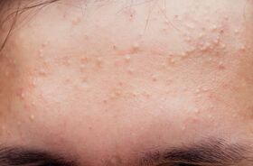 trądzik grudkowy, trądzik grudkowy na czole, trądzik grudkowo-krostkowy