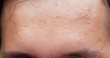 trądzik grudkowy, trądzik grudkowy na czole, trądzik grudkowo-krostkowy