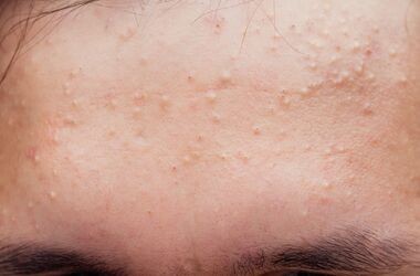 trądzik grudkowy, trądzik grudkowy na czole, trądzik grudkowo-krostkowy