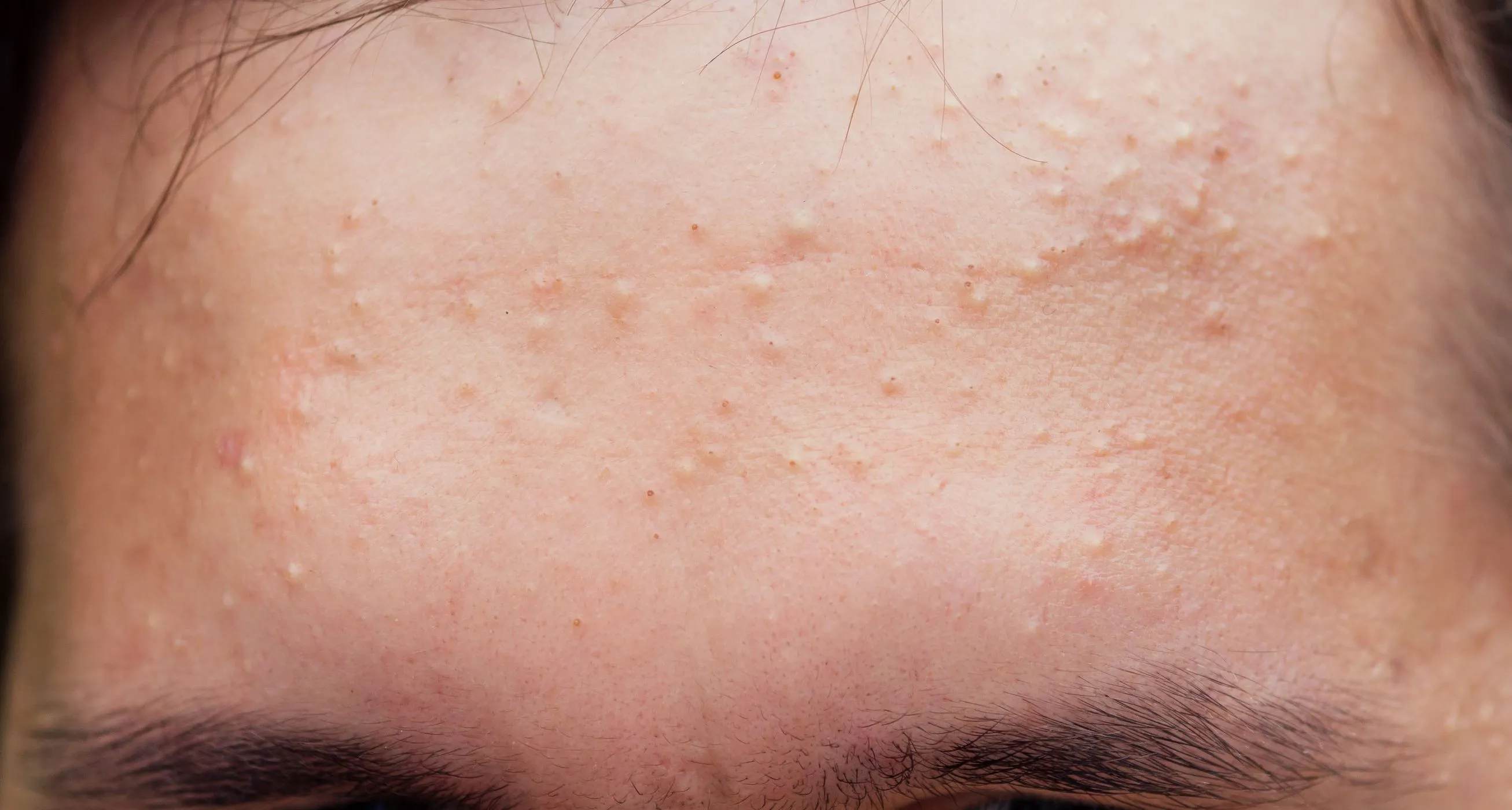 trądzik grudkowy zdjęcie, jak wygląda trądzik grudkowy