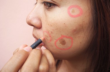 Przebarwienia i plamy na twarzy – przyczyny i sposoby na pozbycie się przebarwień na skórze