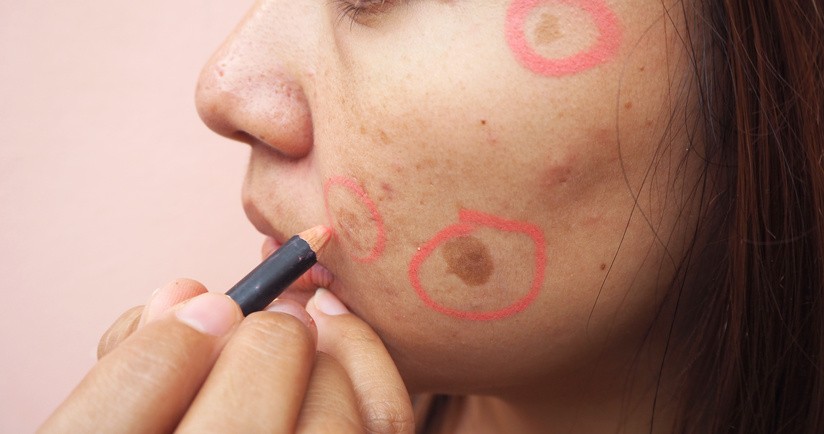 Przebarwienia i plamy na twarzy – przyczyny i sposoby na pozbycie się przebarwień na skórze