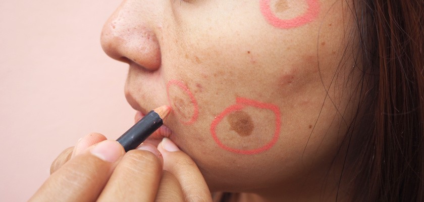 Przebarwienia i plamy na twarzy – przyczyny i sposoby na pozbycie się przebarwień na skórze