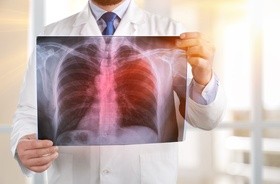Zapalenie płuc na zdjęciu rentgenowskim