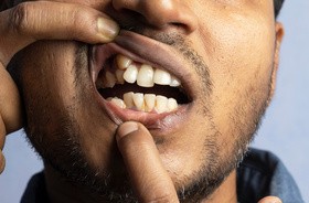 Mężczyzna pokazuje swój nadliczbowy ząb pod górną wargą