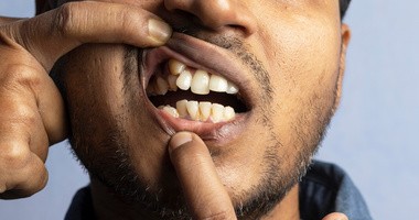 Hiperdoncja - mężczyzna pokazuje swój nadliczbowy ząb pod górną wargą