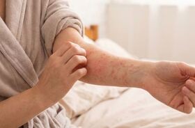 pielęgnacja skóry z AZS, jak pielęgnować skórę z AZS, AZS na kobiecym przedramieniu